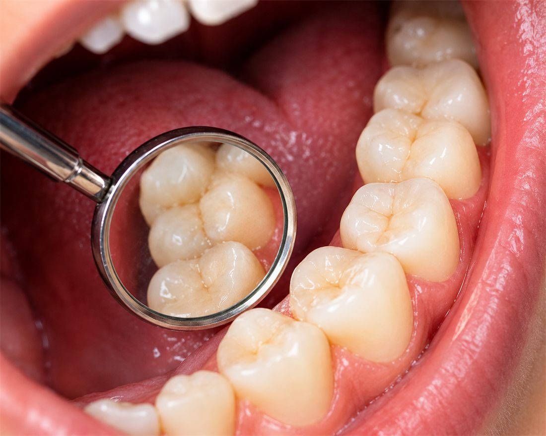 Restorative dentistry at Delhi Dental Cosmetics