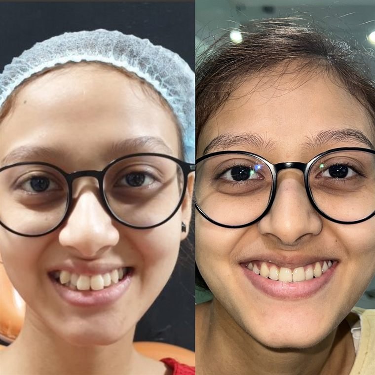 Treatment result at Delhi Dental Cosmetics