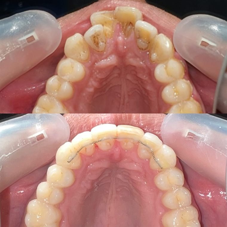 Treatment result at Delhi Dental Cosmetics