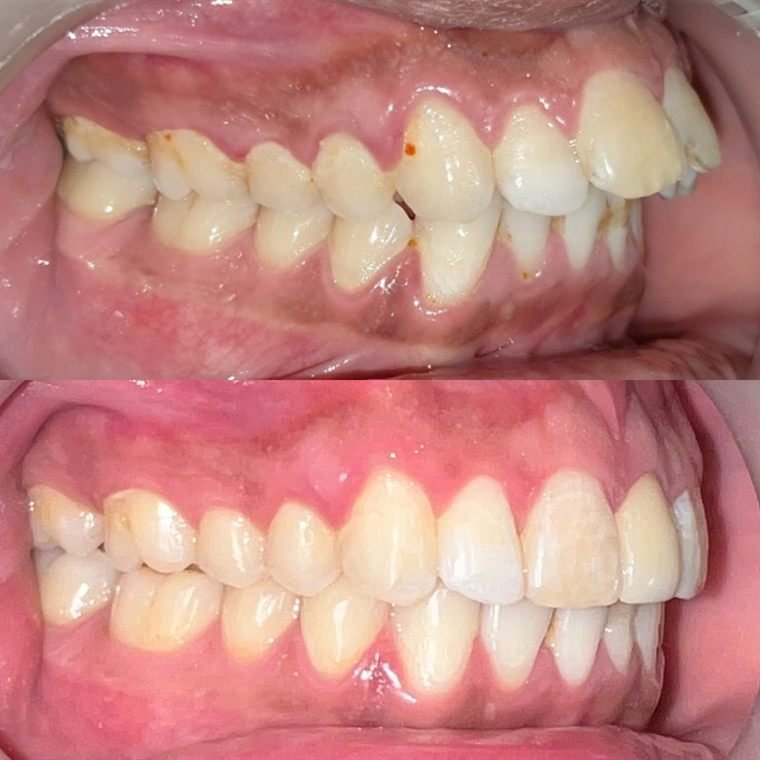 Treatment result at Delhi Dental Cosmetics