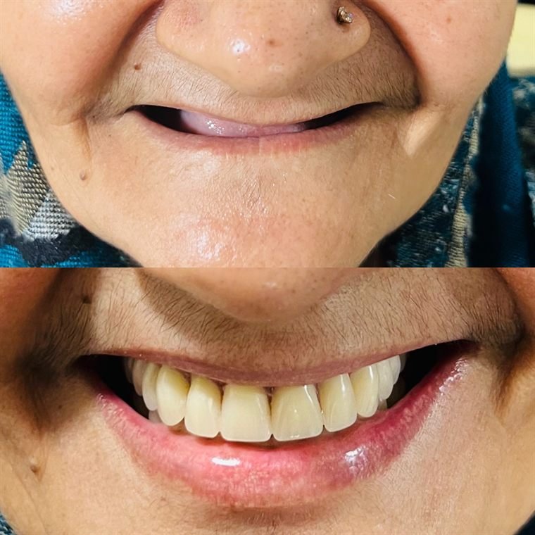 Treatment result at Delhi Dental Cosmetics