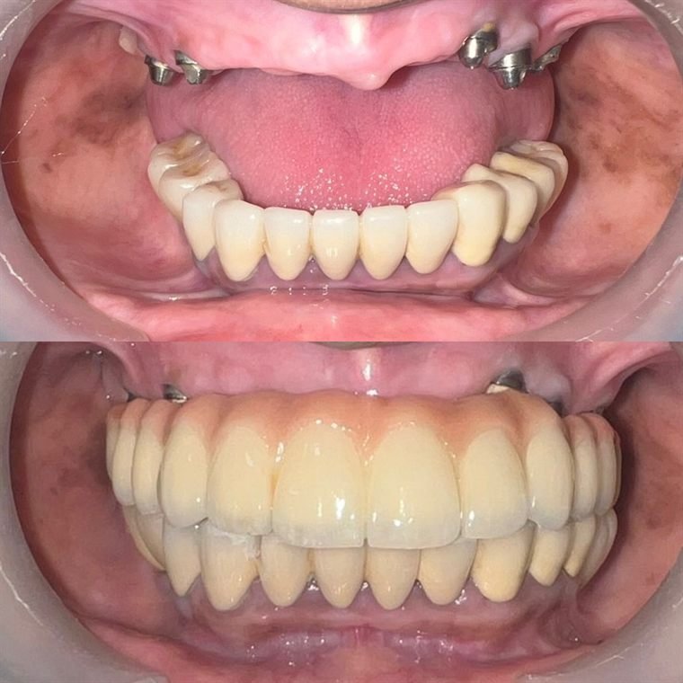 Treatment result at Delhi Dental Cosmetics