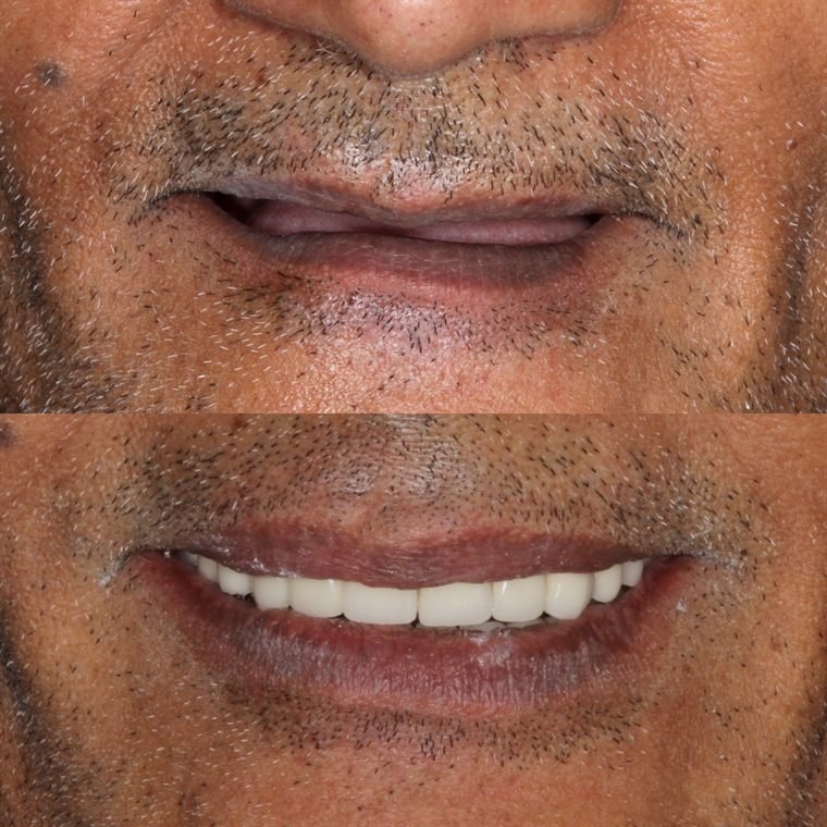 Treatment result at Delhi Dental Cosmetics