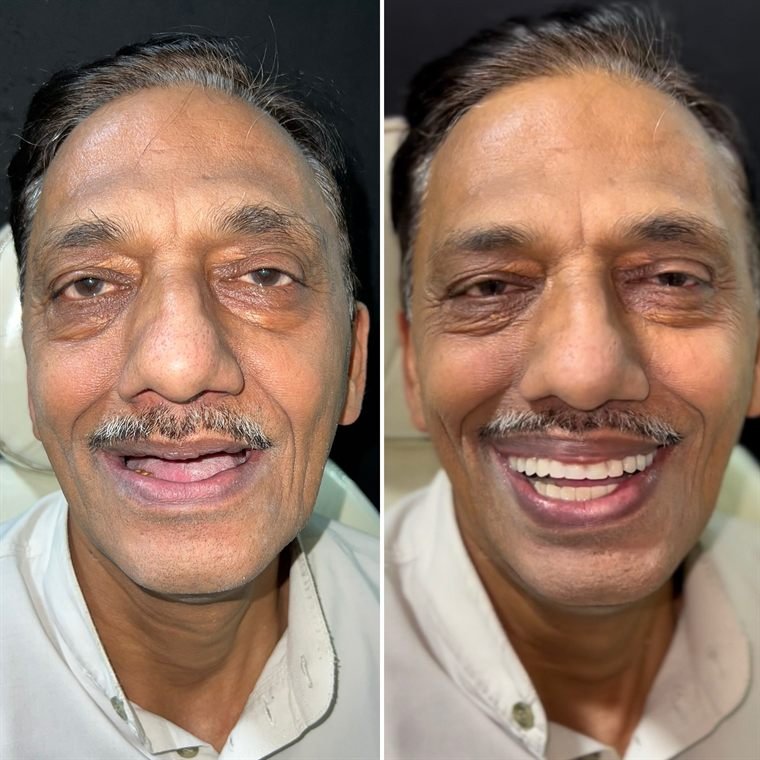 Treatment result at Delhi Dental Cosmetics