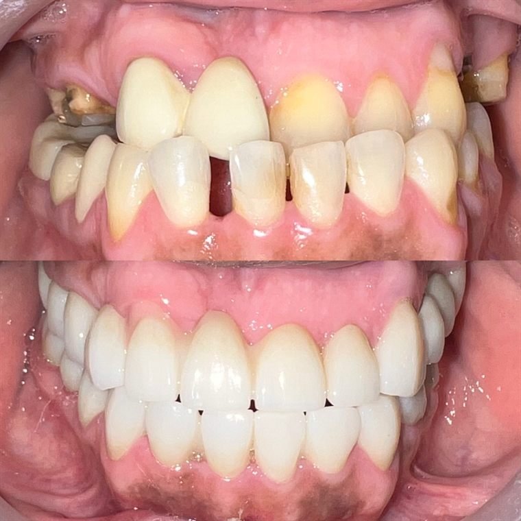 Treatment result at Delhi Dental Cosmetics