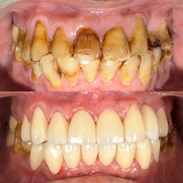Treatment result at Delhi Dental Cosmetics