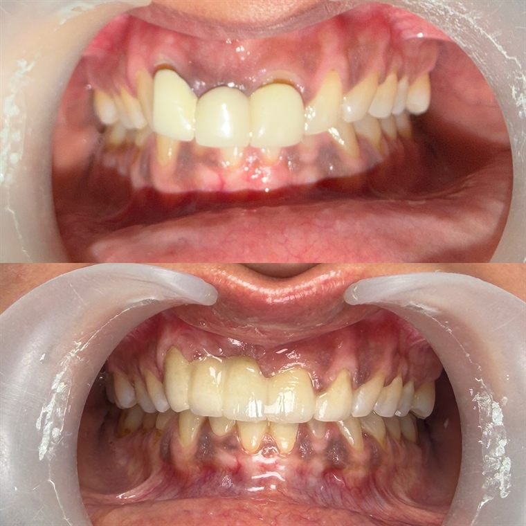 Treatment result at Delhi Dental Cosmetics