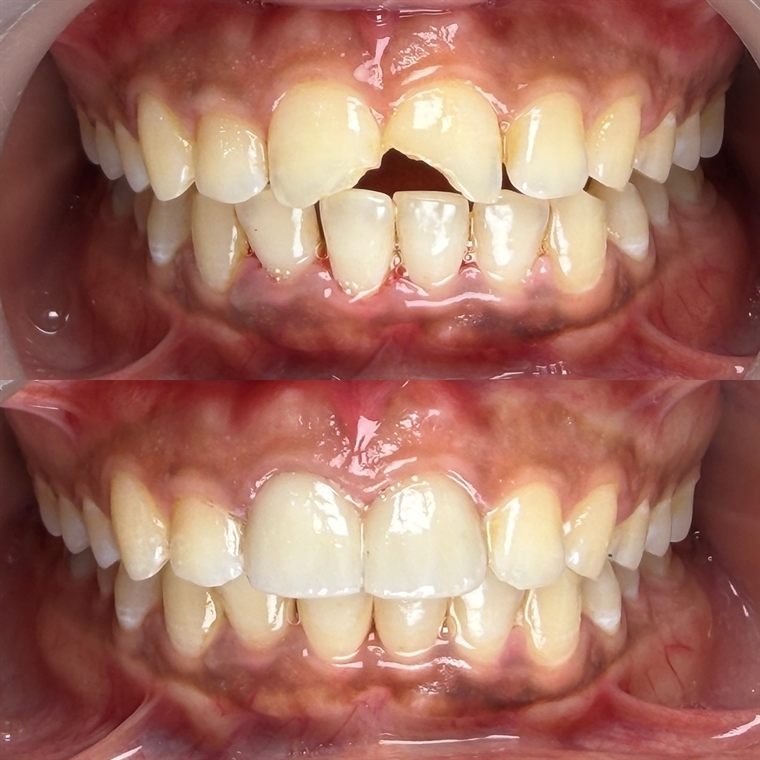 Treatment result at Delhi Dental Cosmetics