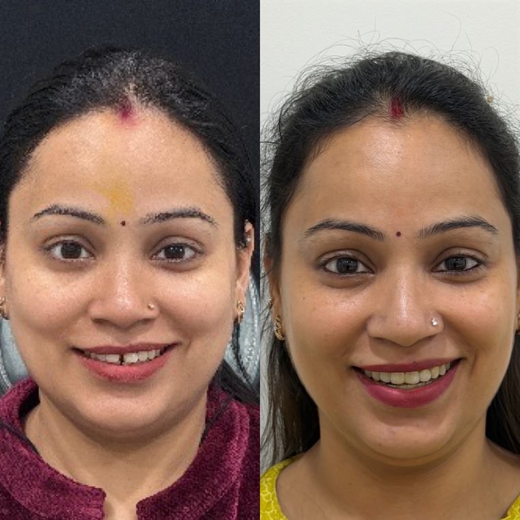 Treatment result at Delhi Dental Cosmetics