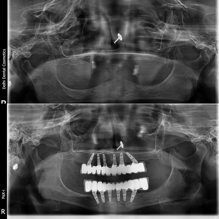 Treatment result at Delhi Dental Cosmetics