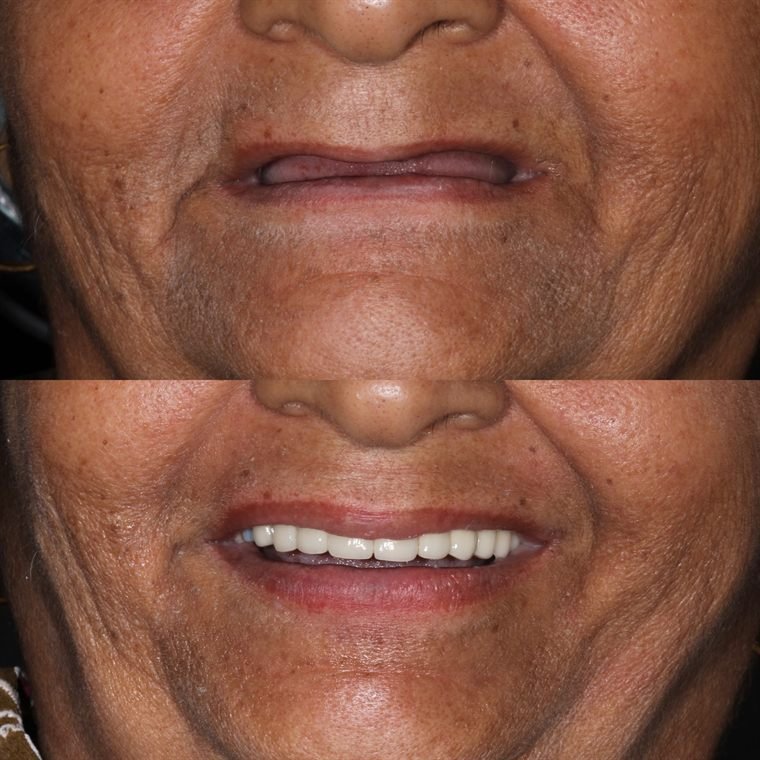 Treatment result at Delhi Dental Cosmetics