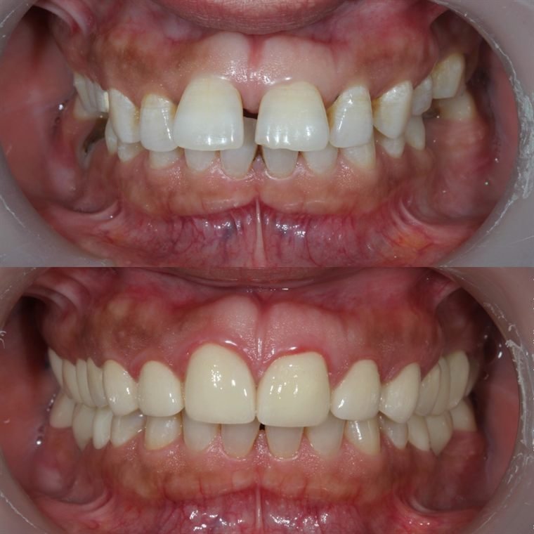 Treatment result at Delhi Dental Cosmetics