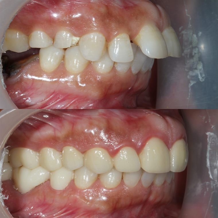 Treatment result at Delhi Dental Cosmetics