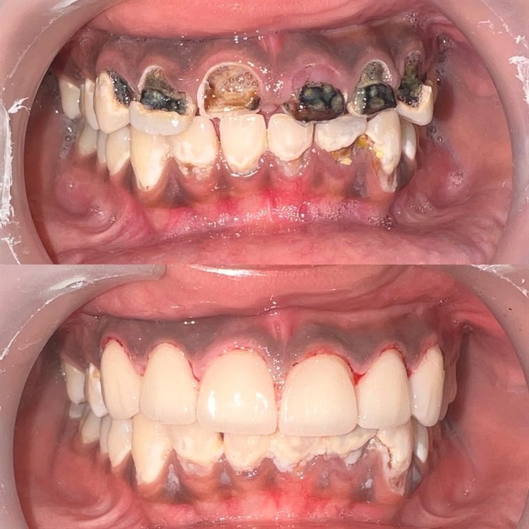 Treatment result at Delhi Dental Cosmetics
