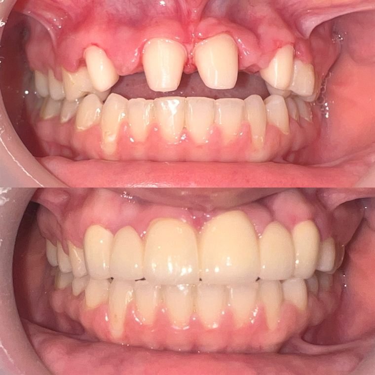 Treatment result at Delhi Dental Cosmetics