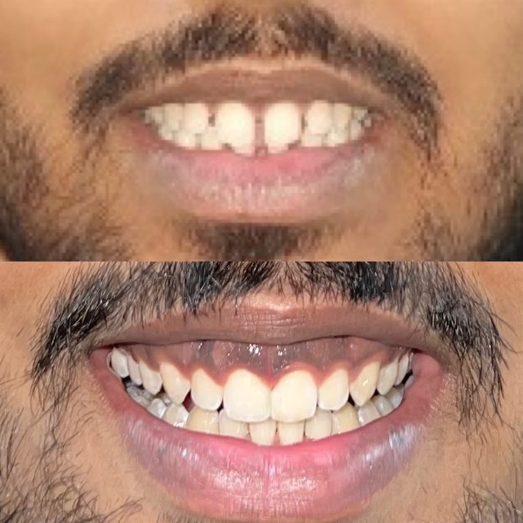 Treatment result at Delhi Dental Cosmetics