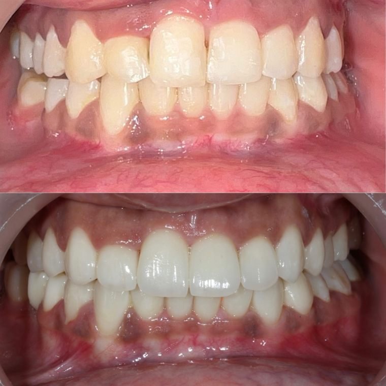 Treatment result at Delhi Dental Cosmetics