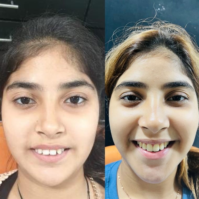 Treatment result at Delhi Dental Cosmetics