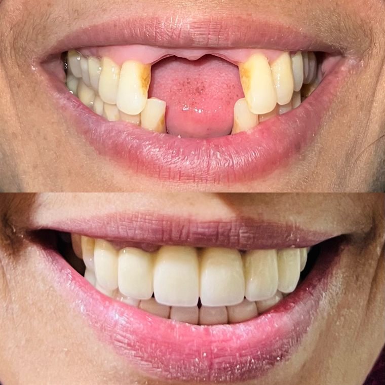 Treatment result at Delhi Dental Cosmetics