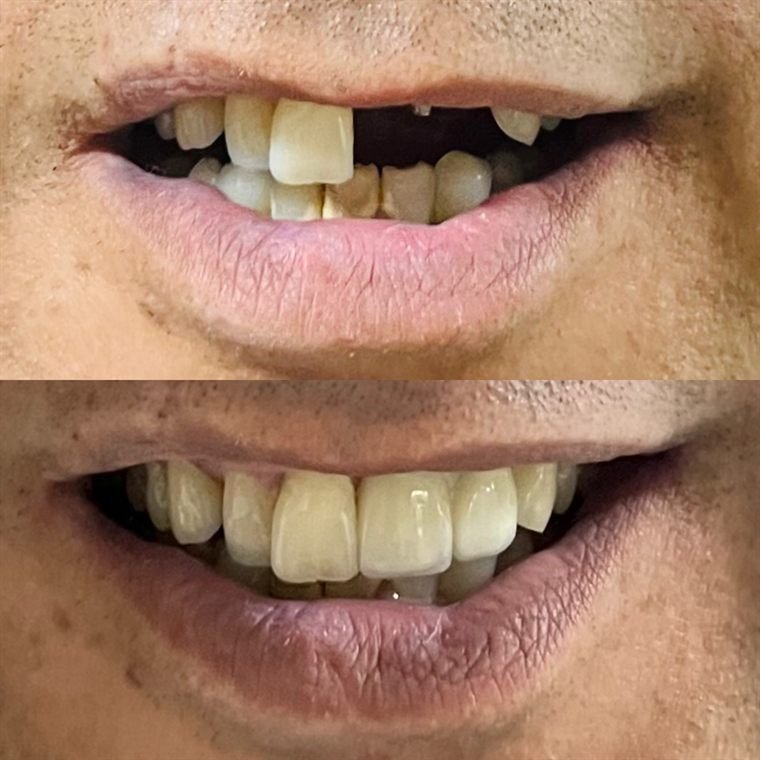 Treatment result at Delhi Dental Cosmetics