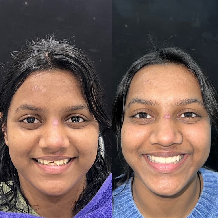 Treatment result at Delhi Dental Cosmetics