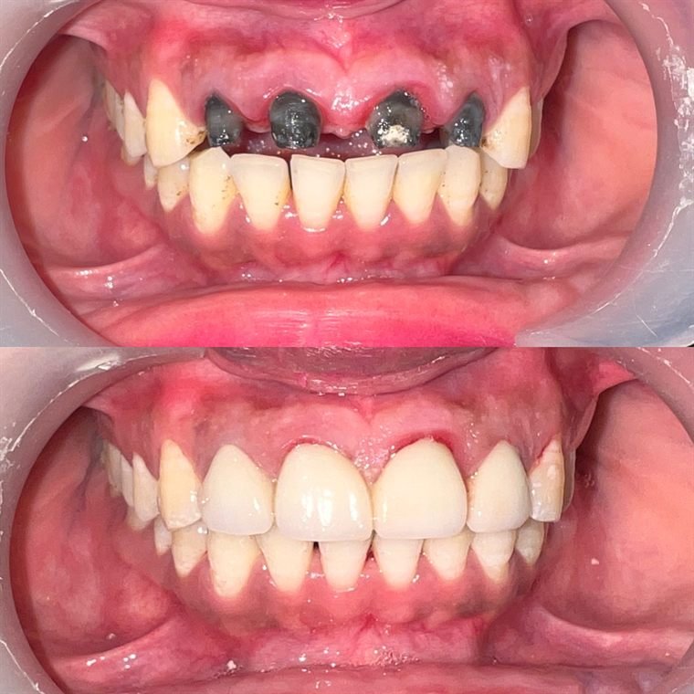 Treatment result at Delhi Dental Cosmetics
