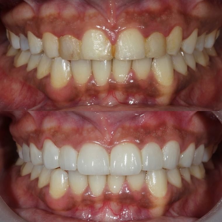 Treatment result at Delhi Dental Cosmetics
