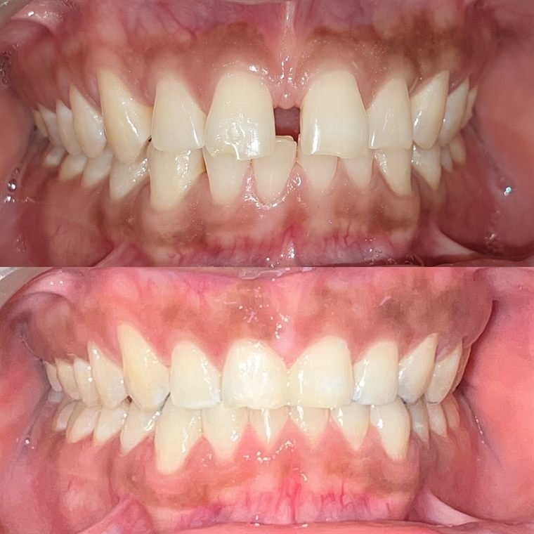Treatment result at Delhi Dental Cosmetics