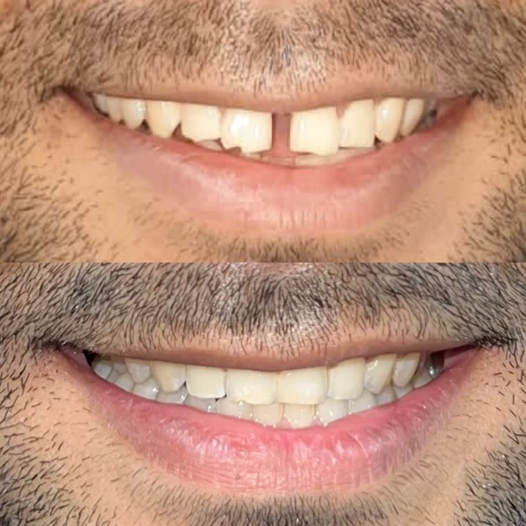 Treatment result at Delhi Dental Cosmetics