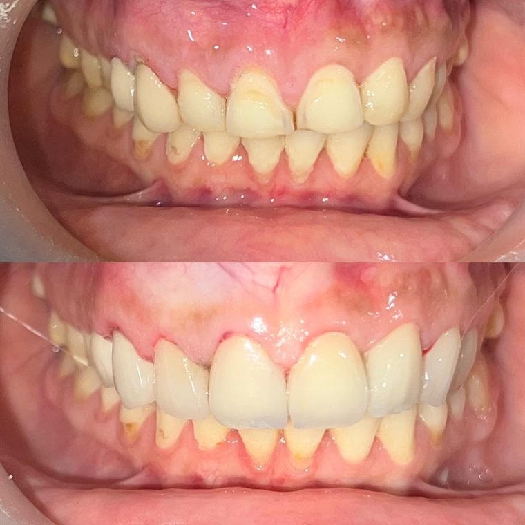 Treatment result at Delhi Dental Cosmetics