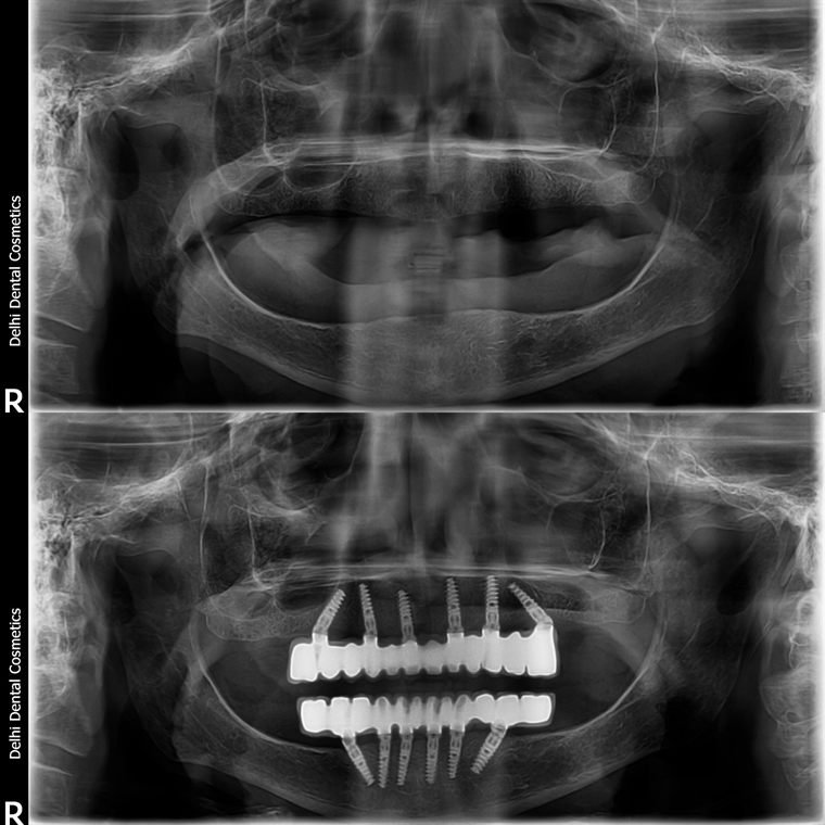 Treatment result at Delhi Dental Cosmetics