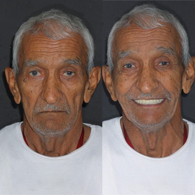 Treatment result at Delhi Dental Cosmetics