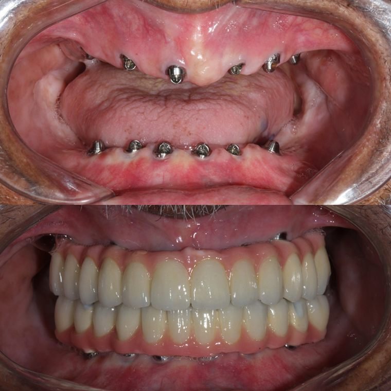 Treatment result at Delhi Dental Cosmetics
