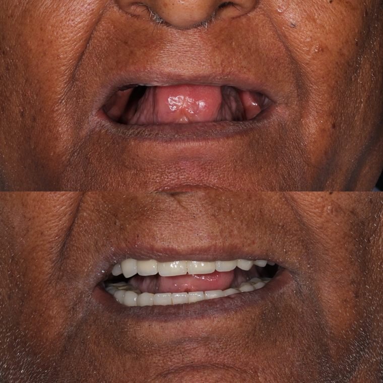 Treatment result at Delhi Dental Cosmetics