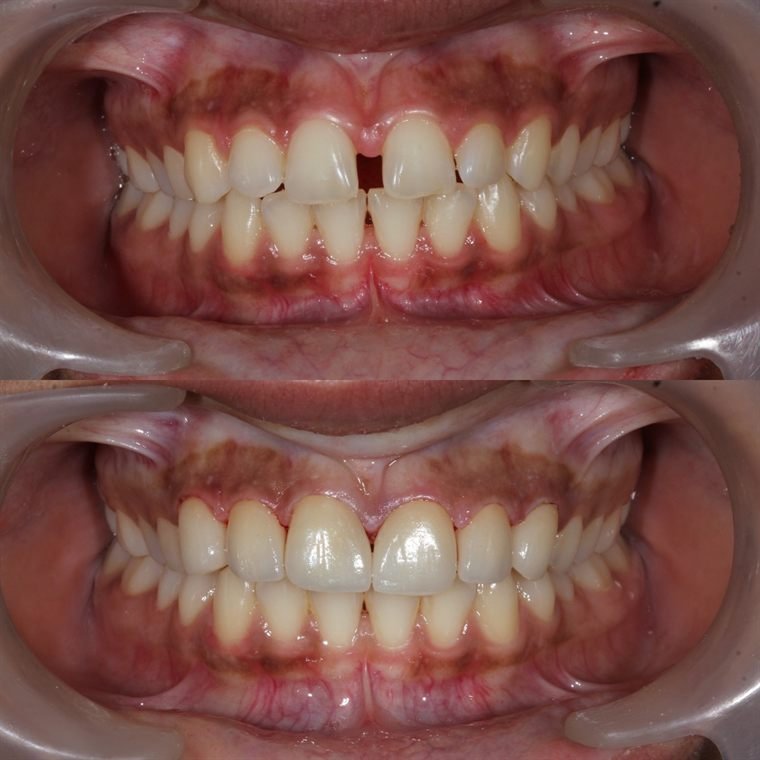 Treatment result at Delhi Dental Cosmetics