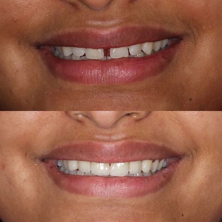 Treatment result at Delhi Dental Cosmetics
